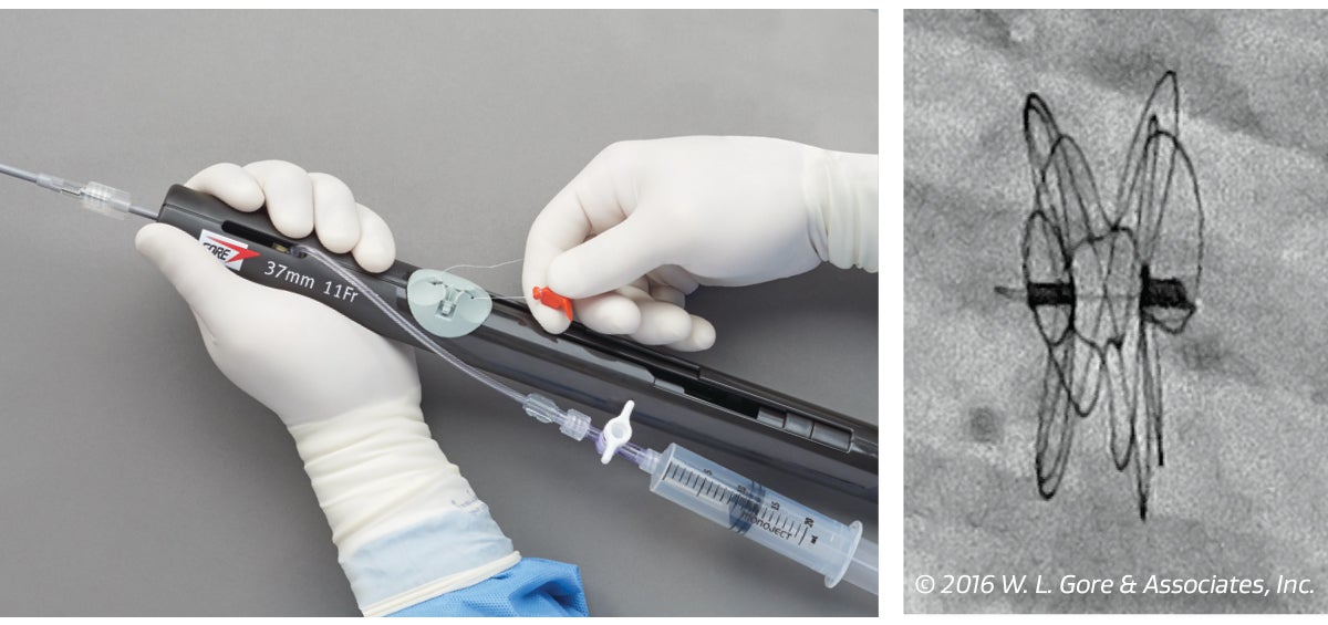 GORE CARDIOFORM ASD Occluder handle in release mode next to a fluoroscopic image of the ASD occluder.