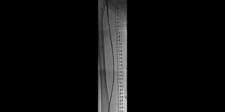 angiogram