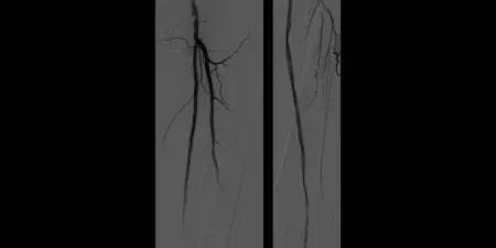 angiogram