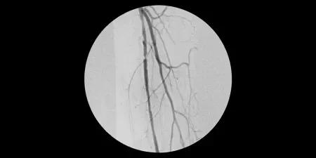 angiogram