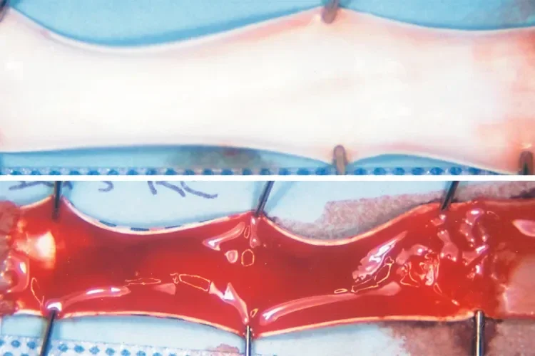 GORE PROPATEN Vascular Graft