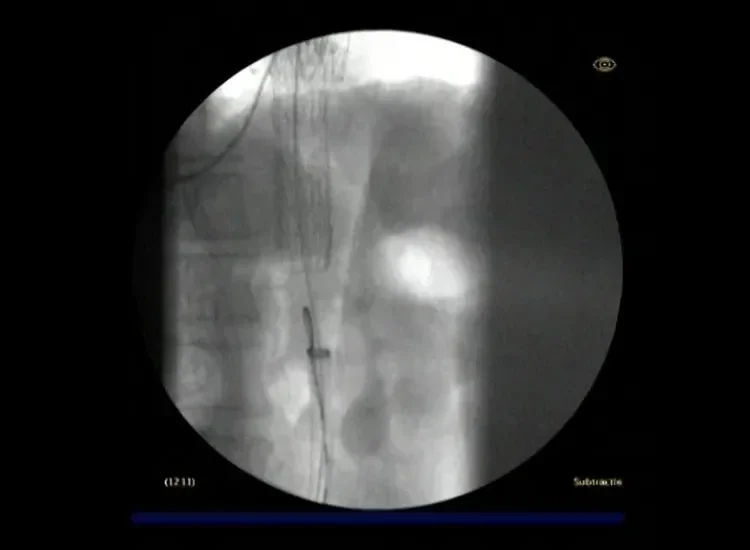 angiogram