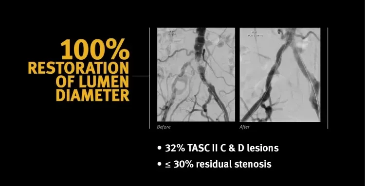 100% restoration of lumen diameter