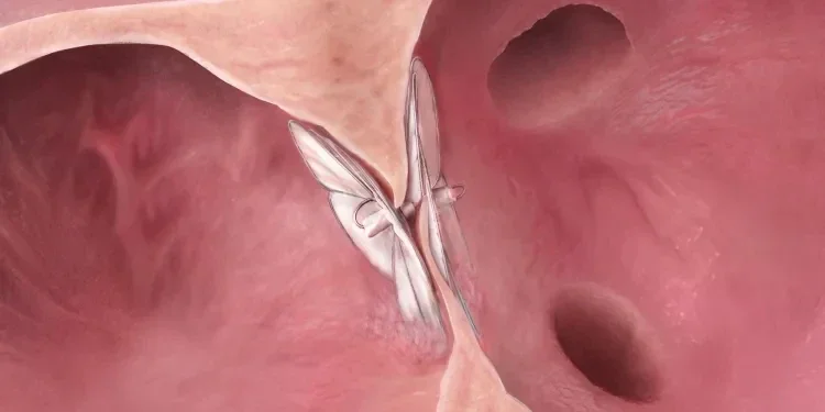 GORE CARDIOFORM Septal Occluder