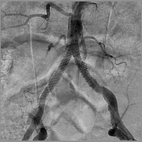 GORE VIABAHN VBX Balloon Expandable Endoprosthesis