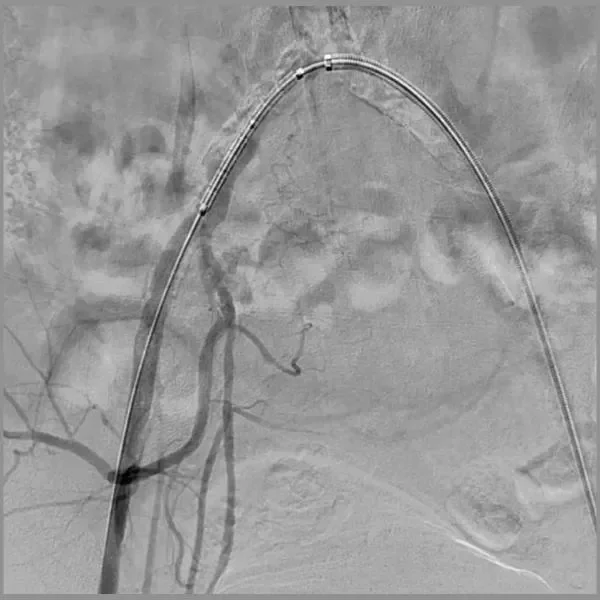 GORE VIABAHN VBX Balloon Expandable Endoprosthesis