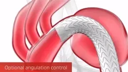 Stent graft deployment