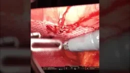 POST-OPERATIVE VIEW: 18-MONTHS POST-IMPLANTATION – RAZVAN OPREANU, M.D. video thumbnail