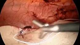 LAPAROSCOPIC VENTRAL HERNIA REPAIR CARL R. DOERHOFF, M.D., FACS video thumbnail