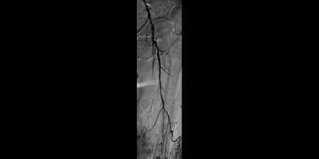 angiogram