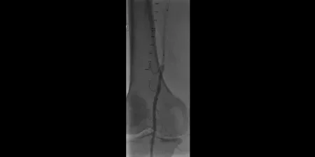 angiogram