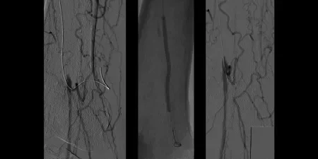 angiogram