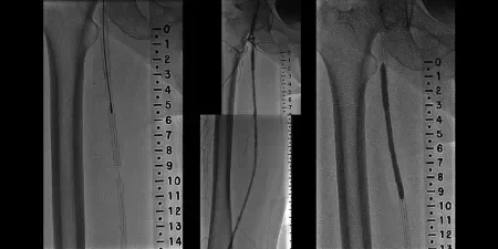 angiogram