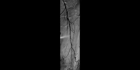 angiogram