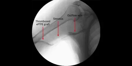 venous anastomosis stenosis with thrombosis