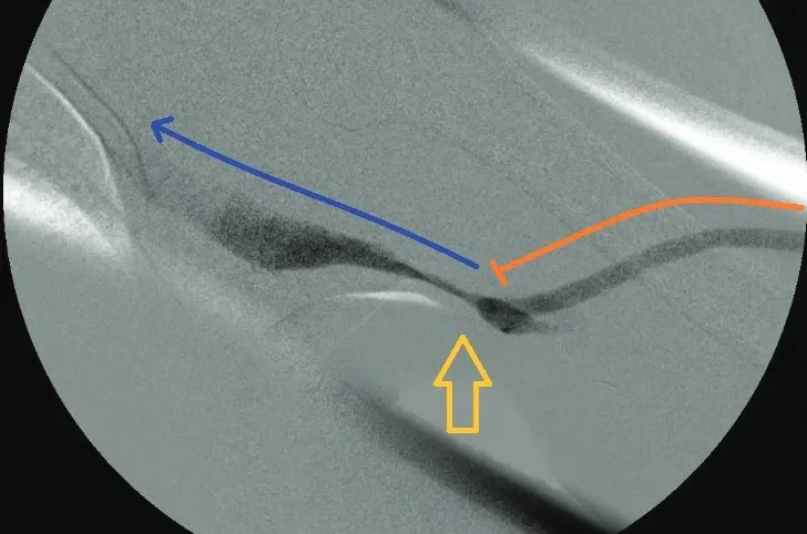 venous anastomosis stenosis