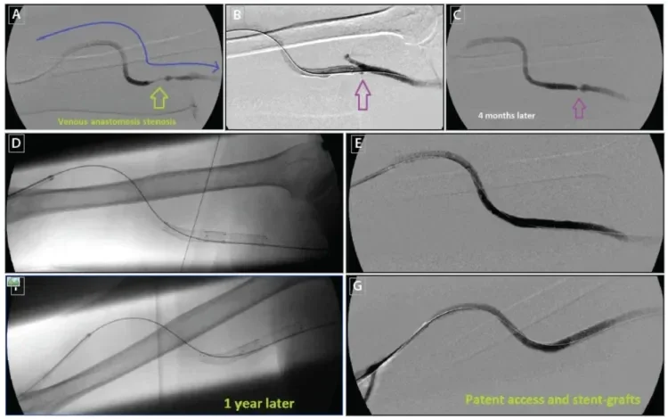 angioplasty