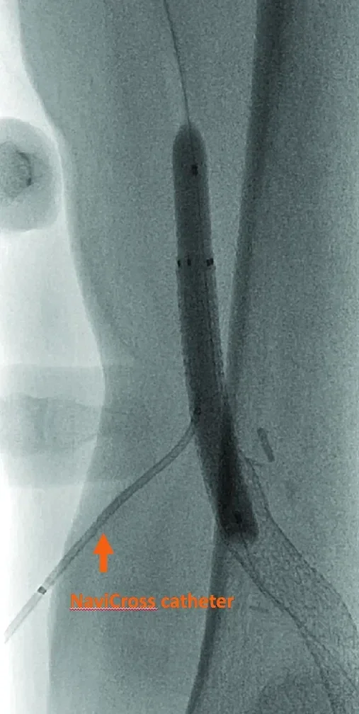 Figure 4. Internal tamponade of retrograde access site.