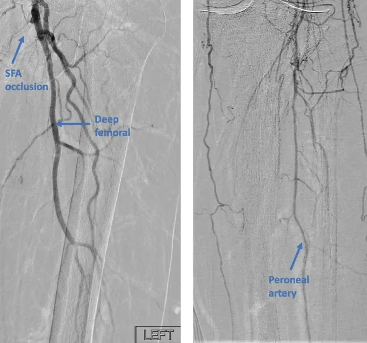 Figure 1. Flush occlusion of the SFA (A). Distal reconstitution of the peroneal artery (B).