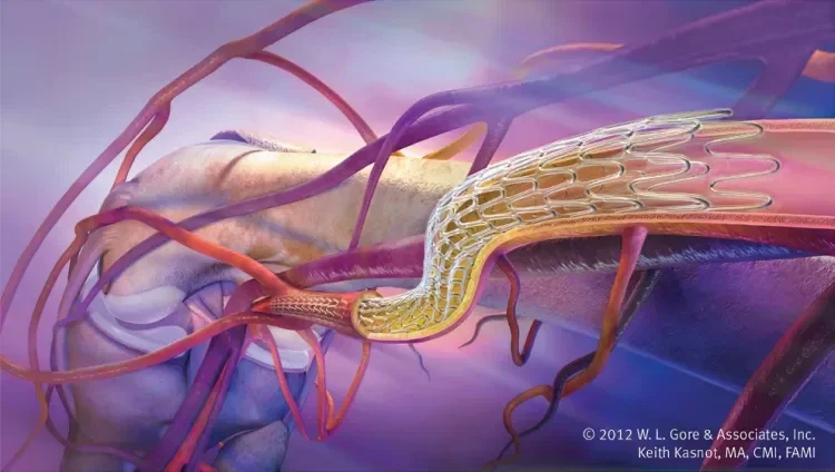 Figure 10. GORE® TIGRIS® Vascular Stent.