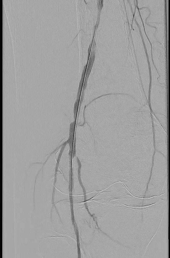 Figure 3. Result after laser atherectomy with a 2-mm SPECTRANETICS® TURBO-ELITE Laser Atherectomy Catheter.