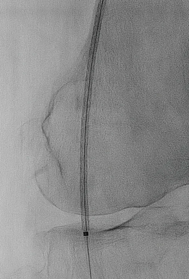 Figure 6. Precision placement of the GORE® TIGRIS® Vascular Stent to the P2 segment and across the adductor hiatus.