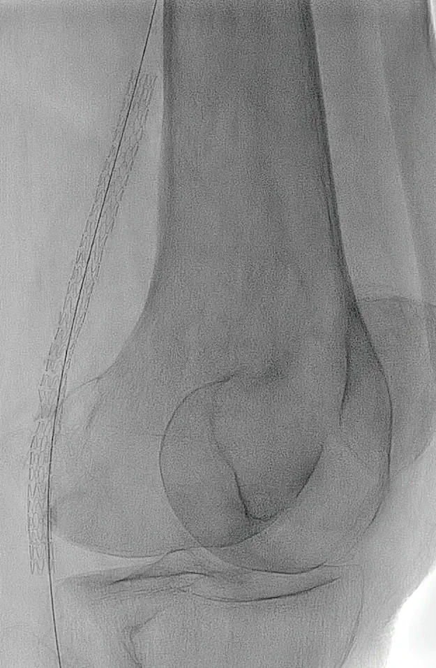 Figure 7. GORE® TIGRIS® Vascular Stent precisely deployed across the adductor hiatus without any elongation or fore shortening.