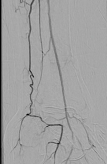 Figure 9. Improved twovessel tibial runoff at case completion.