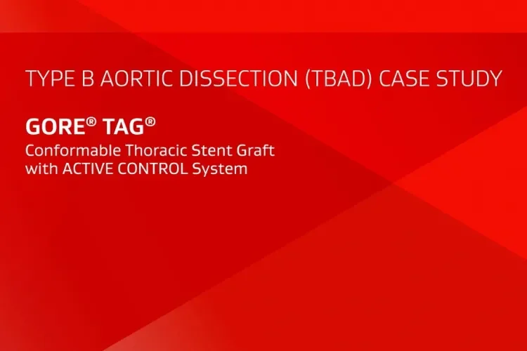 TYPE B AORTIC DISSECTION (TBAD) CASE STUDY