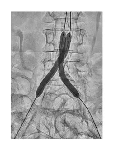 GORE® VIABAHN® VBX Balloon Expandable Endoprosthesis deployment