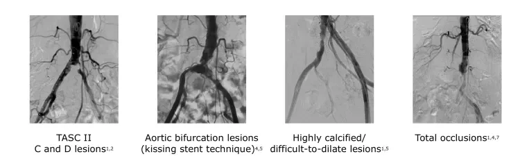 Covered stent grafts