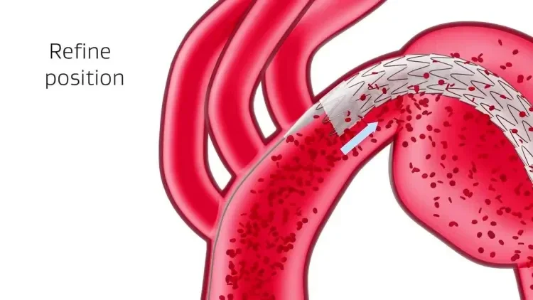 Thumbnail of Hemodynamic Flow