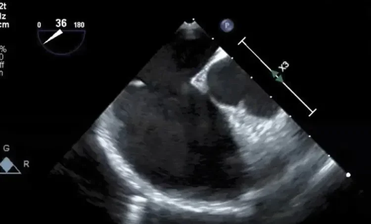 Transesophageal echocardiogram (TEE)