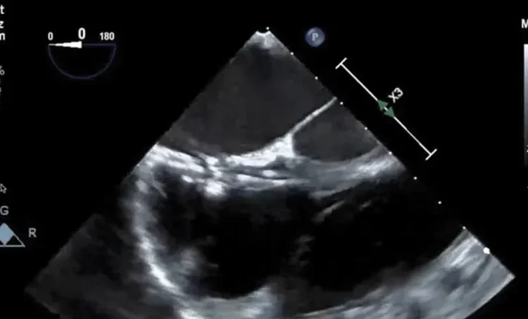 Transesophageal echocardiogram (TEE)