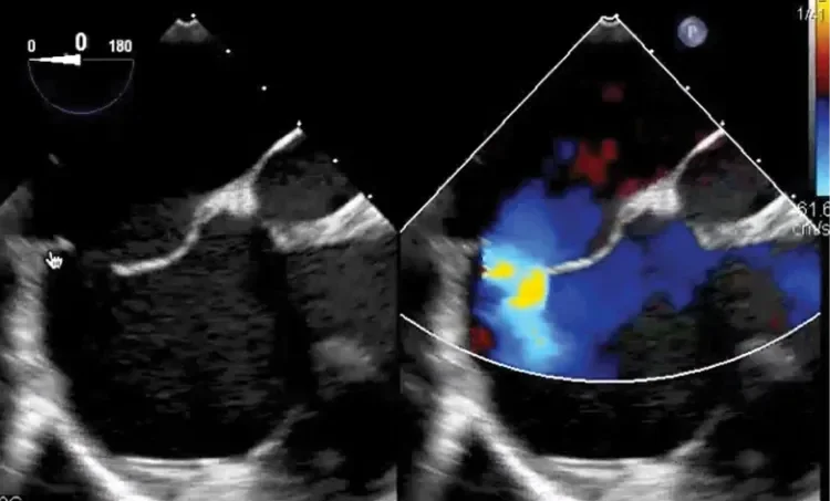 Transesophageal echocardiogram (TEE)