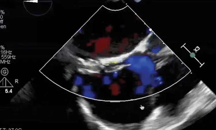 Transesophageal echocardiogram (TEE)