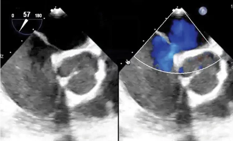 Transesophageal echocardiogram (TEE)