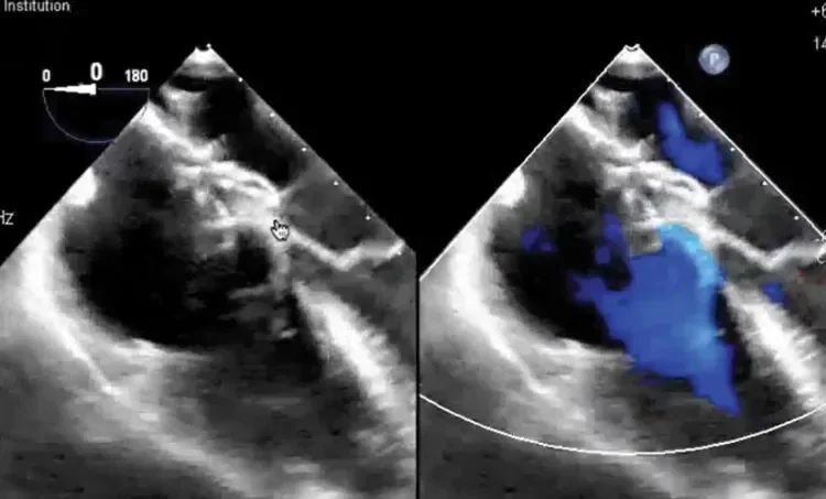 Transesophageal echocardiogram (TEE)