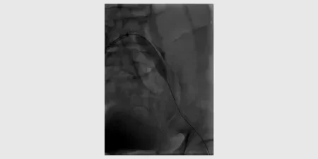 VBX Stent Graft deployment