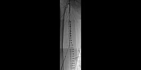 angiogram