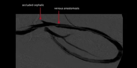 angiogram