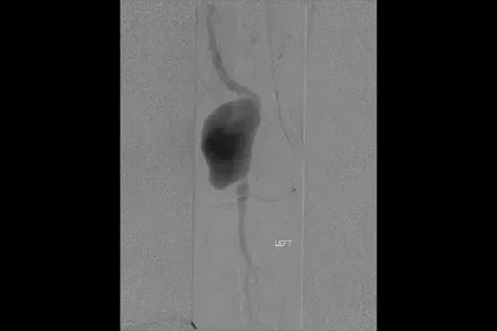 angiogram