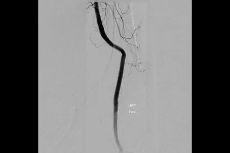 angiogram