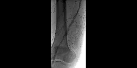 Before: Angiogram shows femoral atherectomy