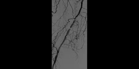 Angiogram