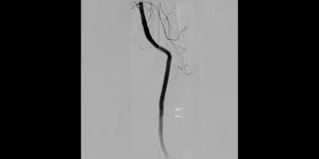 angiogram