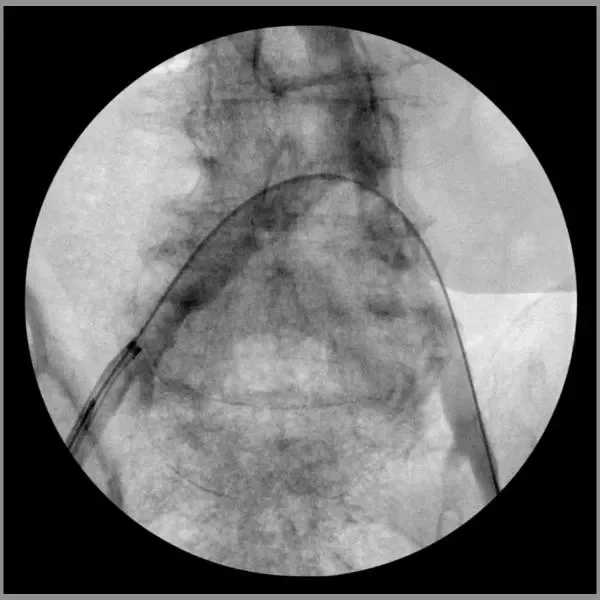 GORE VIABAHN VBX Balloon Expandable Endoprosthesis