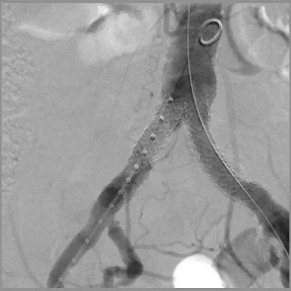 GORE VIABAHN VBX Balloon Expandable Endoprosthesis