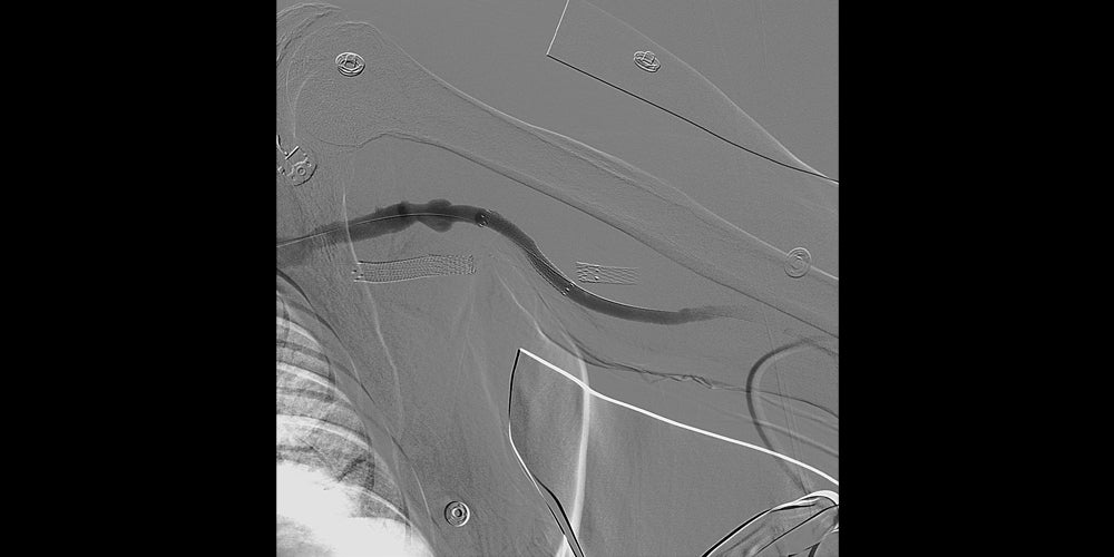 Treating recurrent percutaneous transluminal angioplasty (PTA) failure ...