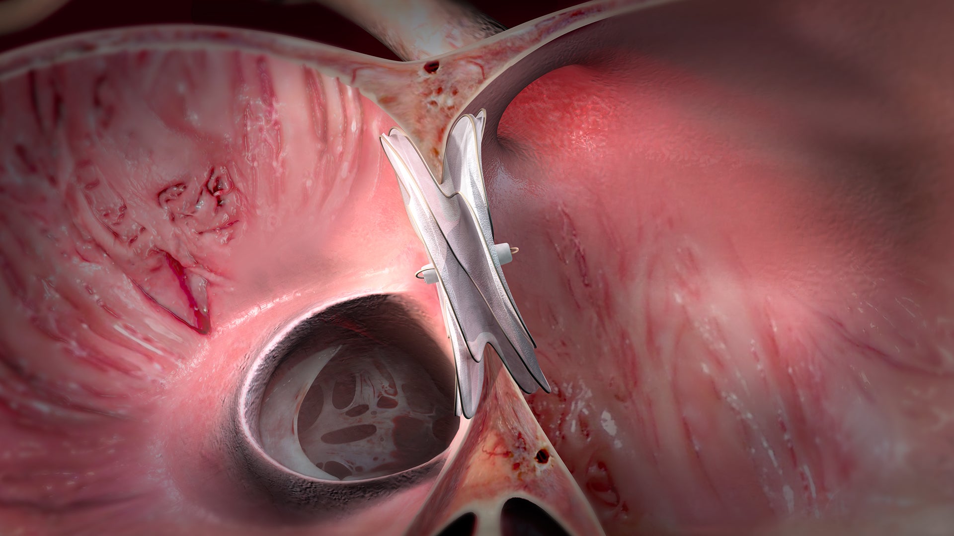 cardiac cardioform asd occluder kasnot